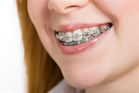 los brackets son de metal|Brackets – Qué son, funcionamiento, cuándo se necesitan y tipos .